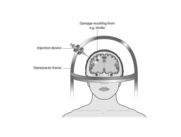 Neural stem cell therapy